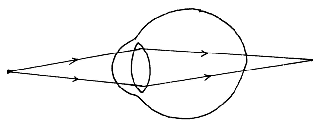 the position of an image formed in a defective eye